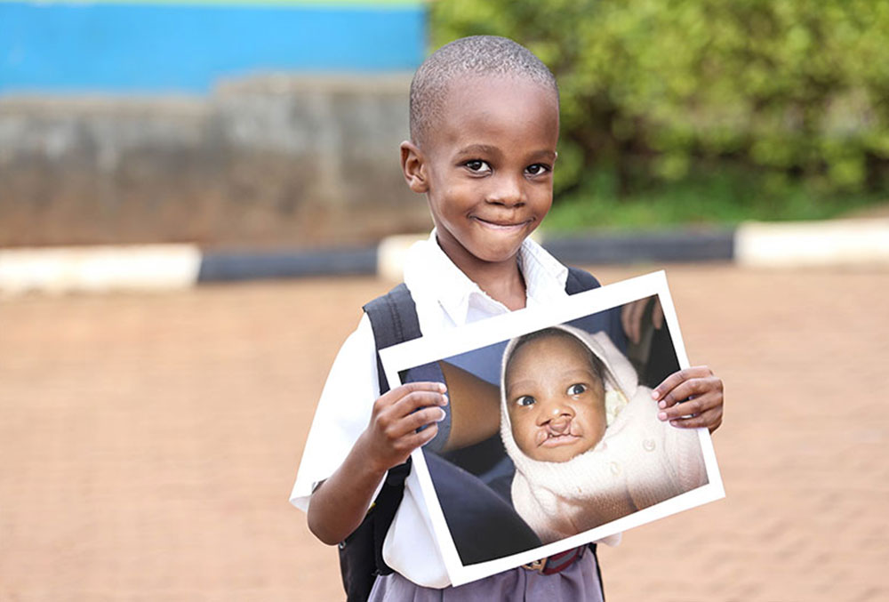 Livingstone souriant et tenant une photo de lui avant une opération de fente