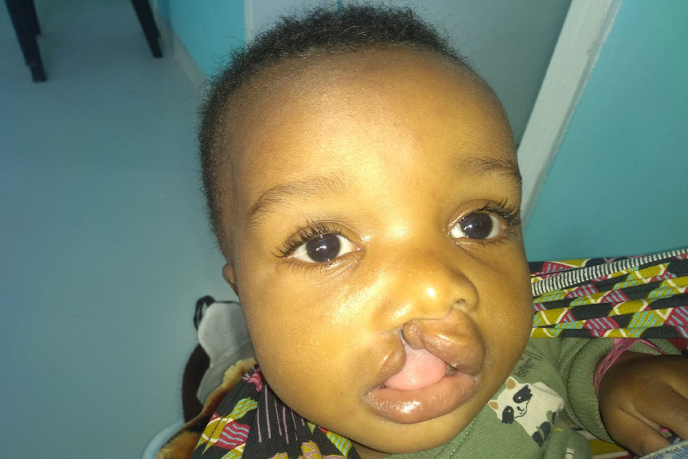 Joshua before cleft surgery