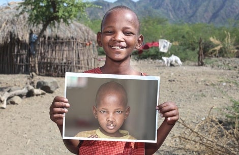 Boy holds up a before surgery image