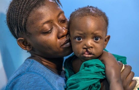 infant held by mother with cleft