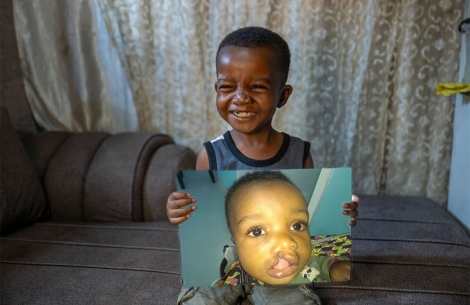 Joshua smiling and holding a photo of himself before cleft surgery