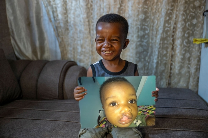 Joshua smiling and holding a photo of himself before cleft surgery