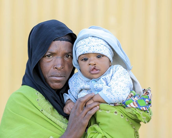 mother holds infant baby with cleft lip