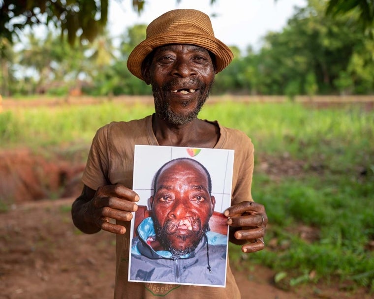 Older man holds picture before his cleft surgery